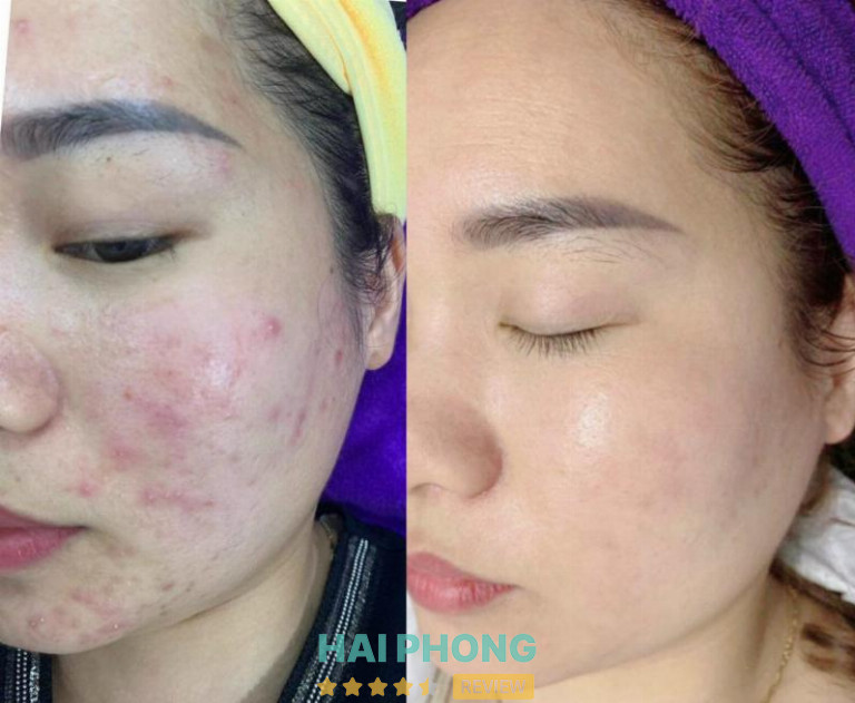 Spa Thùy Dương-Chuyên Tăm Trắng- Trị Mụn Hải Phòng