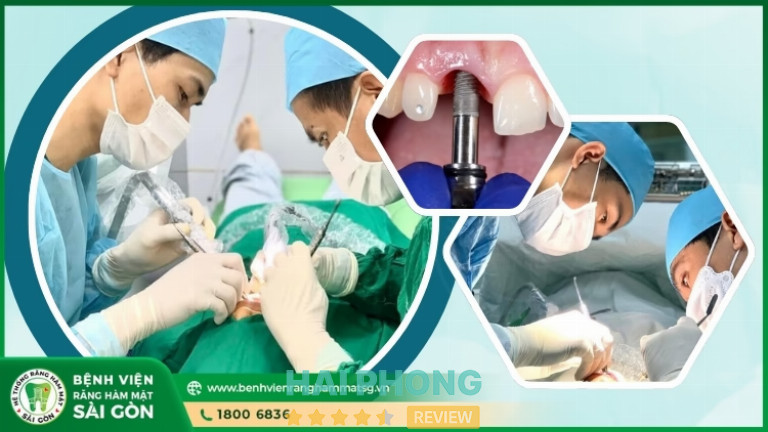 Dịch vụ trồng răng Implant tại Bệnh Viện Răng Hàm Mặt Sài Gòn