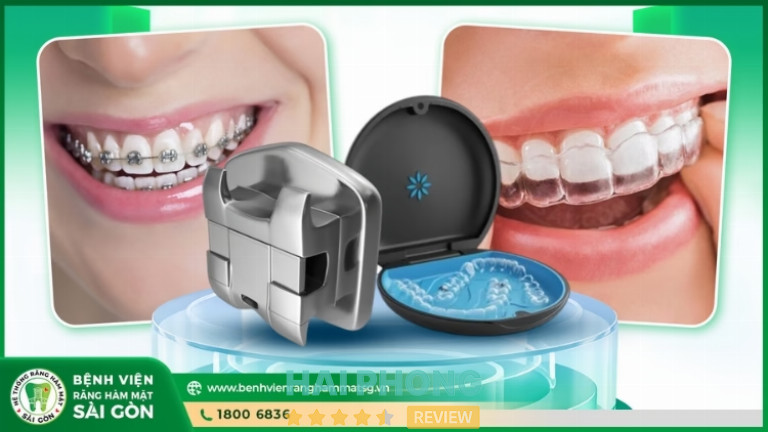 Niềng răng tại Bệnh Viện Răng Hàm Mặt Sài Gòn