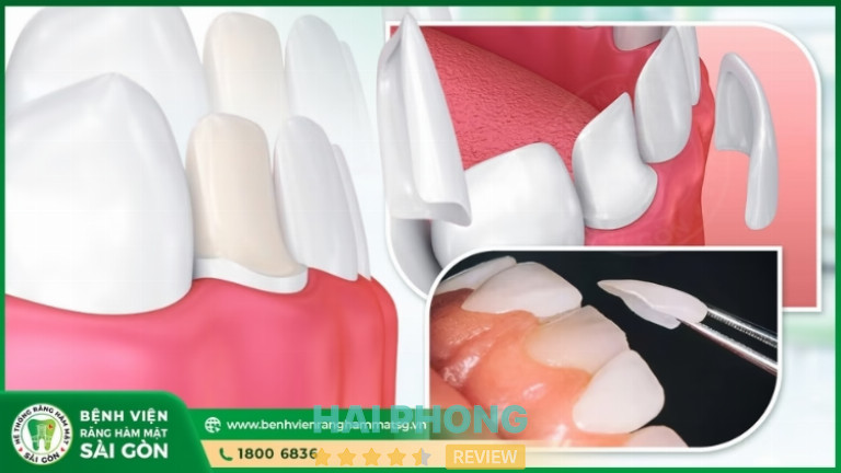 Phục hình răng sứ thẩm mỹ tại Bệnh Viện Răng Hàm Mặt Sài Gòn