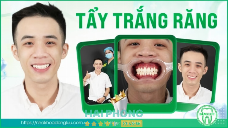 Tẩy trắng răng tại Nha Khoa Đăng Lưu